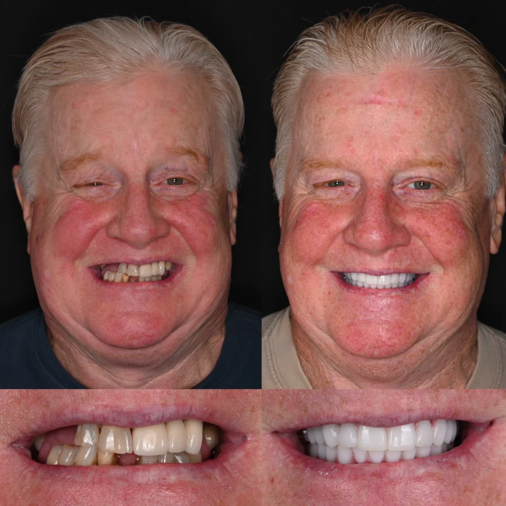 Before and after dental implants in Gallatin, TN at 386 Dental Studio