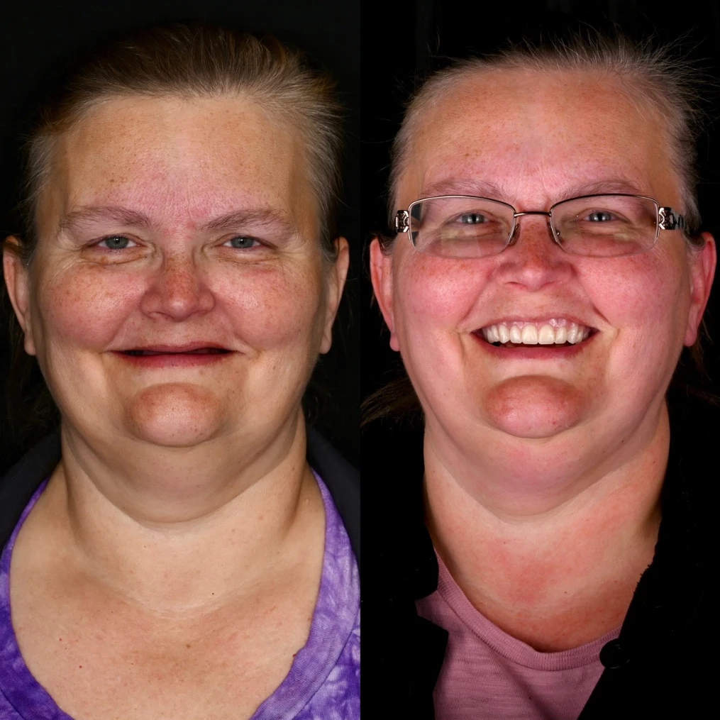 Before and after dental implants in Gallatin, TN at 386 Dental Studio