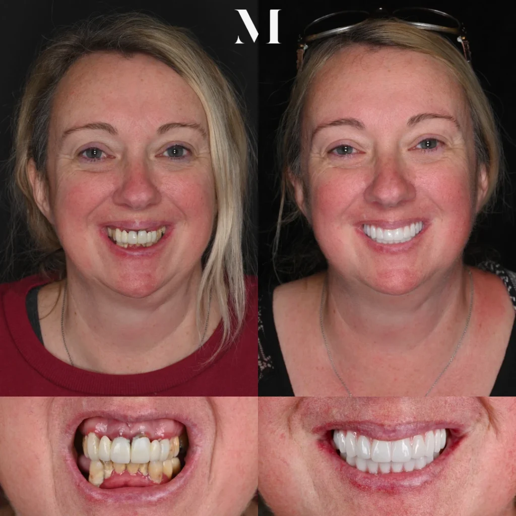 Before and after All-On-X dental implants in Gallatin, TN at 386 Dental Studio